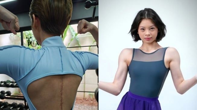 Nada Tarina Pamer Bekas Jahitan Operasi: Kenapa Skoliosis Lebih Rentan Dialami Wanita?